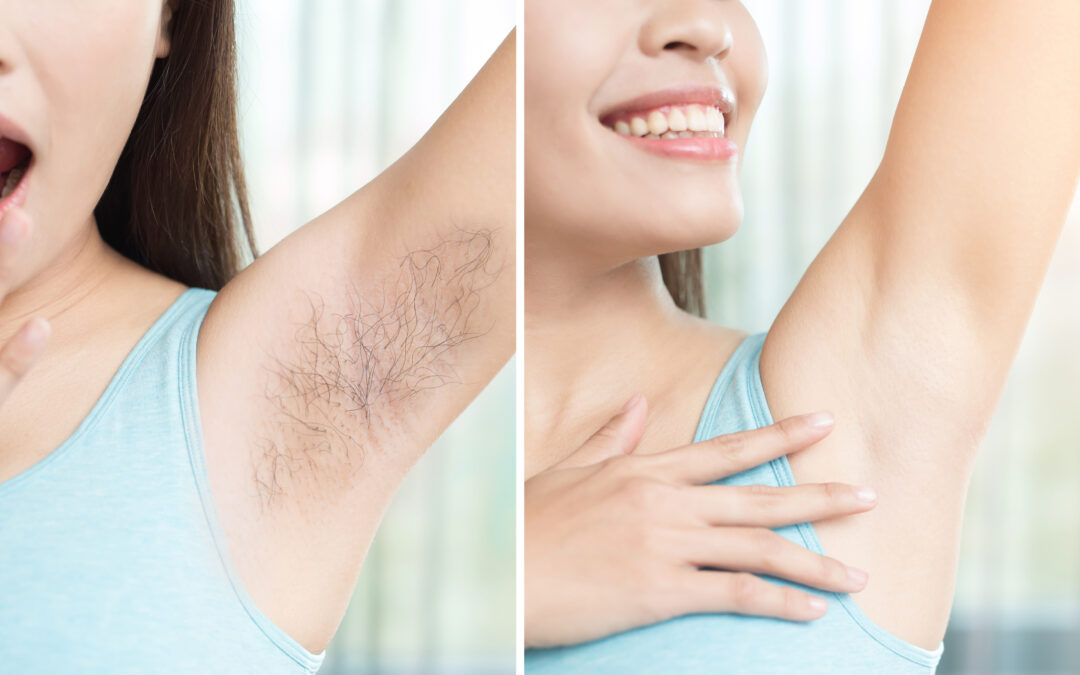 before and after laser hair removal treatment in miami fl