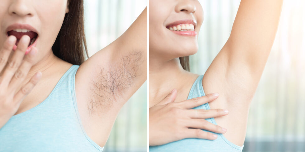 before and after laser hair removal treatment in miami fl