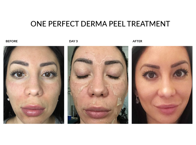 Chemical Peel Before durring and after